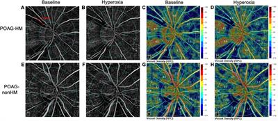 Peripapillary Vascular Reactivity in Primary Open-Angle Glaucoma With High Myopia by Using Optical Coherence Tomography Angiography